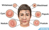 Types of pimples and their easy fixes