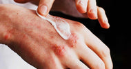 What Is Eczema & The Products You Need