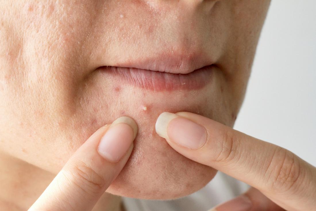 What your acne means