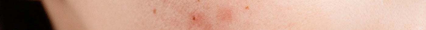 How to treat acne-prone skin without harsh chemicals.