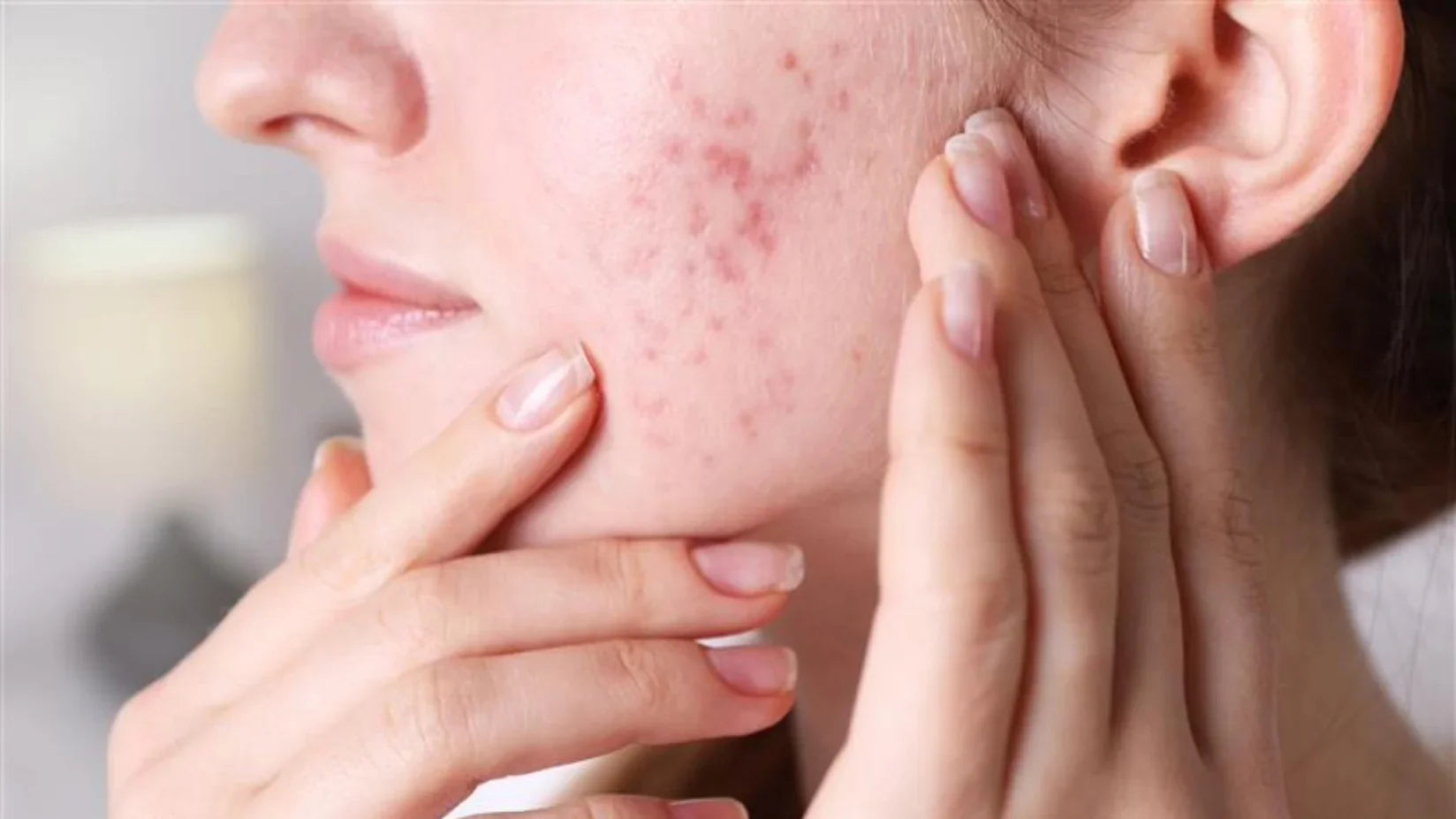 what are the causes of pimples