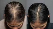 What’s the reason for losing hair?