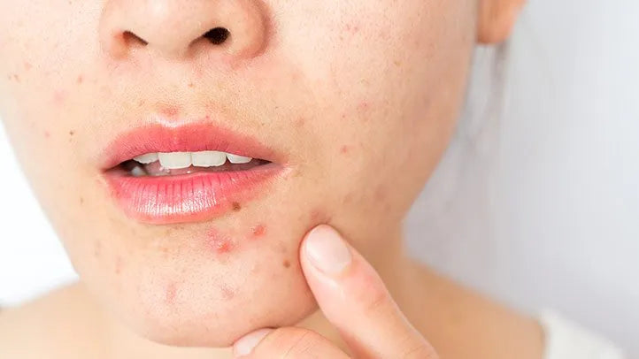 What Are the Causes of Pimples?