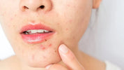 What Are the Causes of Pimples?